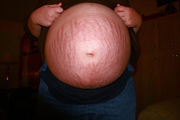 Quels produits utiliser pour éviter les vergetures pendant la grossesse ?